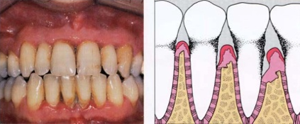 periodontitis