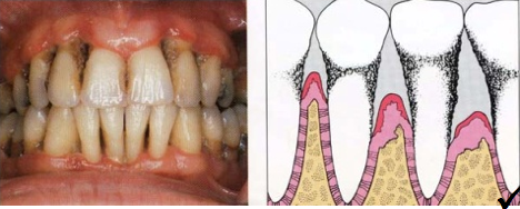 periodontitis avanzada